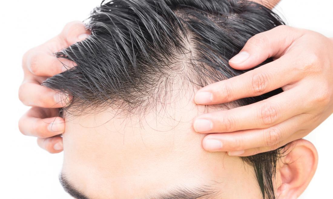 Baldness Treatment for men