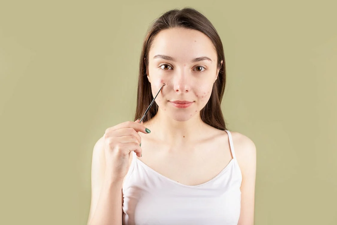 Transforming Your Skin: Laser Treatment For Acne Scars